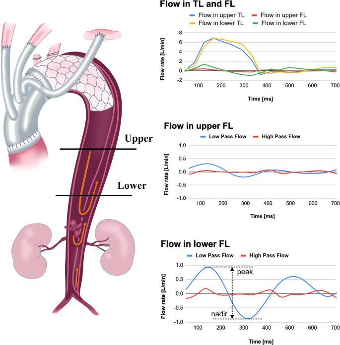 Hemodynamic predictors of negative false lumen remodeling after frozen elephant trunk for acute aortic dissection.