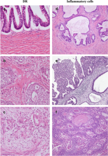 Pathological classification of desmoplastic reaction is prognostic factor in cervical adenocarcinoma.