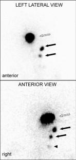 Sentinel node mapping in conjunctival and eyelid malignancies: a mini-review