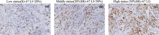 Non-Gaussian model-based diffusion-weighted imaging of oral squamous cell carcinoma: associations with Ki-67 proliferation status.