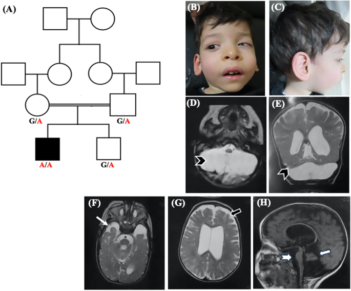 A missense variant in EXOSC8 causes exon skipping and expands the phenotypic spectrum of pontocerebellar hypoplasia type 1C