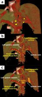 Hand-assisted laparoscopic splenectomy and gastropancreatic fold division: a less-invasive simplified technique of Hassab's procedure for refractory esophagogastric varices.