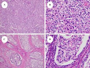 Immunohistochemical and molecular analysis of an α-fetoprotein-producing cervical adenocarcinoma with clear cell morphology.