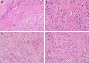 Usefulness of SynCAM3 and cyclin D1 immunohistochemistry in distinguishing superficial CD34-positive fibroblastic tumor from its histological mimics.