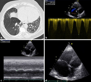 [Pulmonary hypertension associated with lung disease].