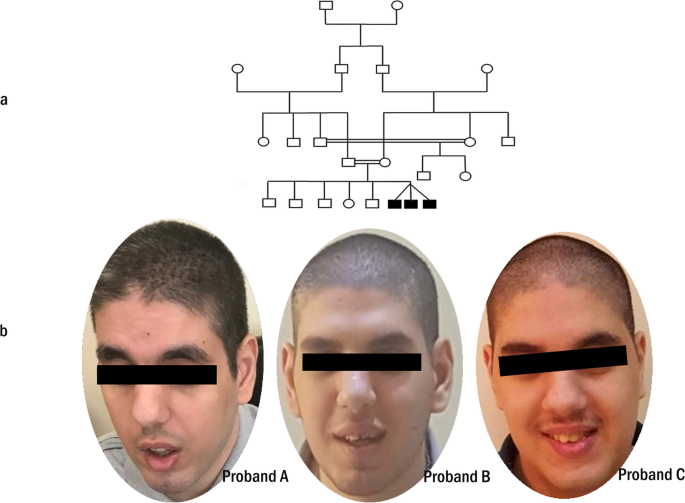 Cohen syndrome and early-onset epileptic encephalopathy in male triplets: two disease-causing mutations in VPS13B and NAPB.