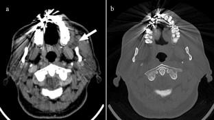 A case of odontogenic keratocyst in the buccal space: characterization by multimodality imaging including computed tomography, diffusion-weighted magnetic resonance imaging, and ultrasonography.