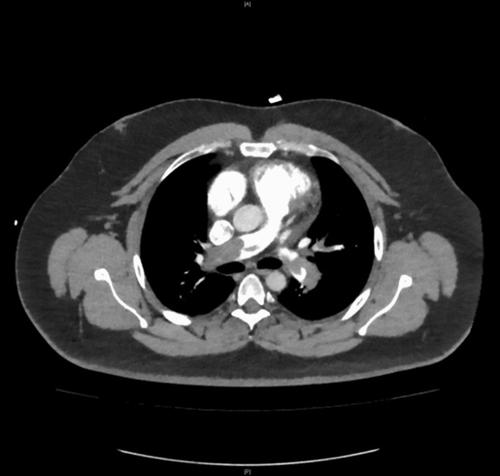 Spontaneous blood pressure reduction of previously hypertensive patients as a symptom of central pulmonary artery embolism.