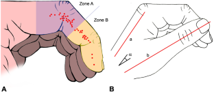 Implications of thumb position and trajectory in tetraplegia grip reconstruction - a cohort study.