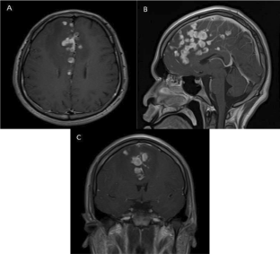 Primary anaplastic large cell lymphoma arising from central nervous system