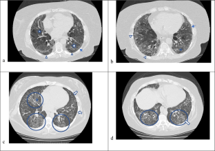 Interstitial Lung Disease in ANCA-Associated Vasculitis: Pathogenic Considerations and Impact for Patients' Outcomes.