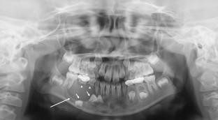 A case of radicular cyst on deciduous tooth in a 7-year-old child.