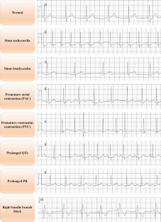 Comparison of Machine Learning Algorithms Using Manual/Automated Features on 12-Lead Signal Electrocardiogram Classification: A Large Cohort Study on Students Aged Between 6 to 18 Years Old.