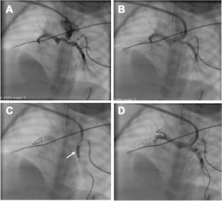 Stent Strut Dilation in Branch Pulmonary Artery Stenosis Following Stenting of Arterial Duct in Duct-dependent Pulmonary Circulation.