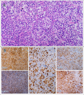 CD5 as a prognostic marker in patients with diffuse large B-cell lymphoma: a multicenter study