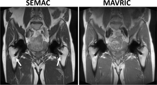 The role of advanced metal artifact reduction MRI in the diagnosis of periprosthetic joint infection.