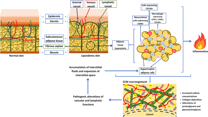 Ketogenic Diet: A Nutritional Therapeutic Tool for Lipedema?