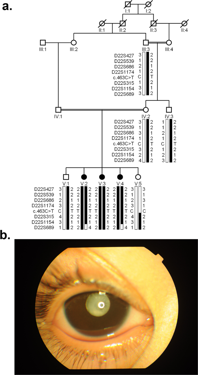 A genomic deletion encompassing CRYBB2-CRYBB2P1 is responsible for autosomal recessive congenital cataracts.