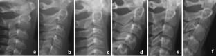 Deep convolutional neural network-the evaluation of cervical vertebrae maturation.