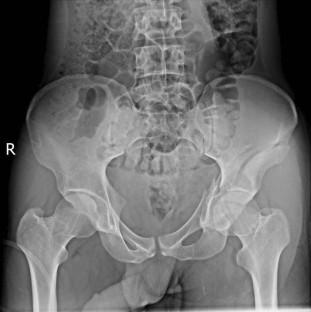 Clinical results of acetabular fracture treatment with hybrid fixation by anterior and posterior approach : A minimally invasive technique.