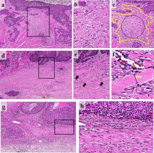 Prognostic impact of desmoplastic reaction in esophageal squamous cell carcinoma patients with neoadjuvant therapy.