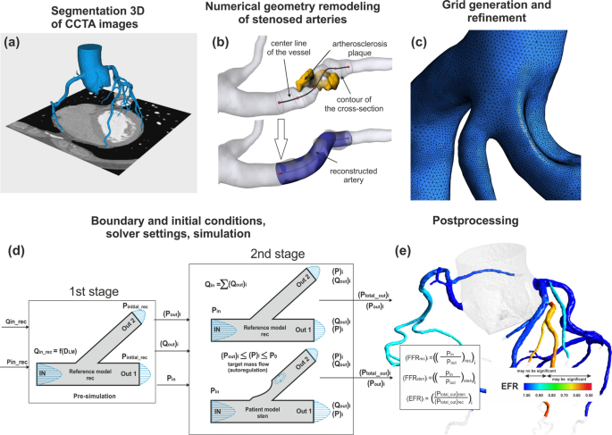 The Comparative Method Based on Coronary Computed Tomography Angiography for Assessing the Hemodynamic Significance of Coronary Artery Stenosis.