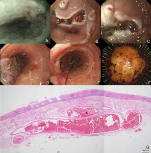 Safety and efficacy of endoscopic submucosal dissection for superficial esophageal cancer with esophageal varices.