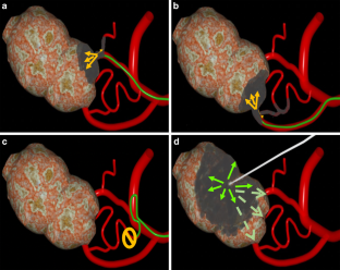 Preoperative Direct Puncture Embolization Using a Nonadhesive Ethylene Vinyl Alcohol (EVOH) Liquid Embolic Agent for Head and Neck Paragangliomas