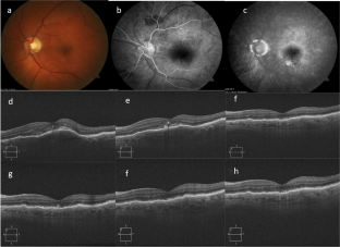 Real-world experience with brolucizumab in neovascular age-related macular degeneration over 2 years: the REBA extension study