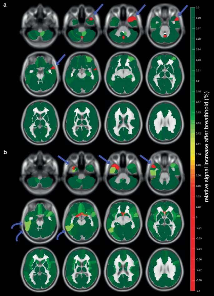 Breath-Hold-Triggered BOLD fMRI in Drug-Resistant Nonlesional Focal Epilepsy—A Pilot Study