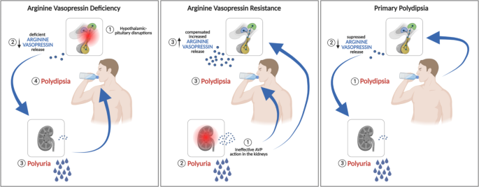 New insights on diagnosis and treatment of AVP deficiency