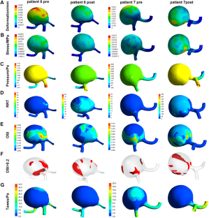 Proximal Clipping and Distal High-Flow Bypass in the Treatment of Giant/Complex Intracranial Aneurysm: An Opportunity or a Risk from a Fluid-Structural Interaction Analysis