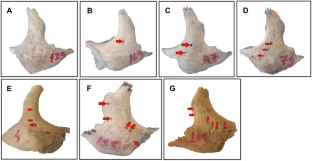 Anatomical variations of the zygomaticofacial foramen and its related canal through the zygomatico-orbital and zygomaticotemporal foramina in dry human skulls