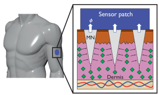 Performance gain and electro-mechanical design optimization of microneedles for wearable sensor systems