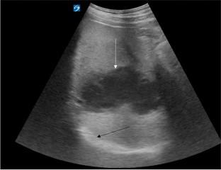 A pickup for a case of hiccups: point-of-care ultrasonography detects a liver abscess in a 74-year-old gentleman