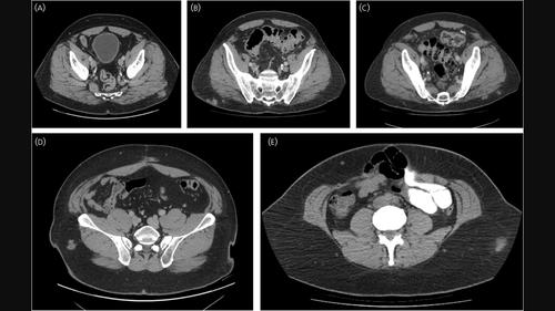 Clinical impact of unsuccessful subcutaneous administration of octreotide LAR instead of intramuscular administration in patients with metastatic gastroenteropancreatic neuroendocrine tumors