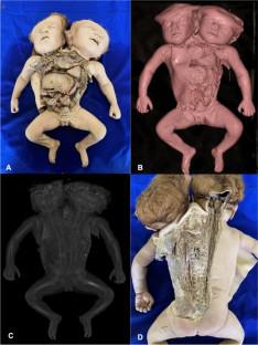 Morphological variations on vital systems in a conjoined twin