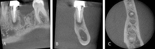 Incidental findings in cone beam computed tomography (CBCT) scans for implant treatment planning: a retrospective study of 404 CBCT scans