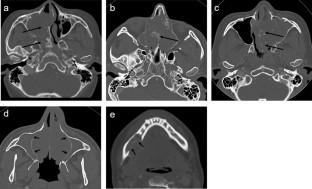 CT and MR imaging findings of head and neck chondrosarcoma