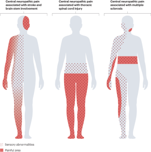 Central neuropathic pain.