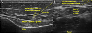 Temperature-Mediated Neural Interventions in Knee Osteoarthritis: a Review of Cryoneurolysis and Cooled Radiofrequency Ablation with Ultrasound Guidance.