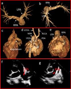 Cross or Not to Cross-Dilemma of the Pulmonary Arteries.