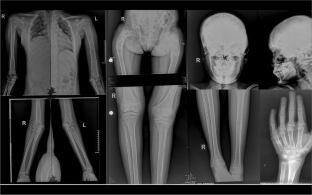 Metastatic Adrenocortical Carcinoma as an Unusual Cause of Hypercortisolism in McCune-Albright Syndrome: a Case Report