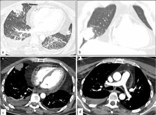 Initial diagnosis of extranodal NK/T-cell lymphoma in pericardial fluid with concomitant hemophagocytic lymphohistiocytosis (HLH)