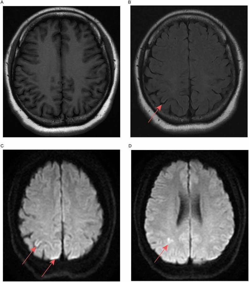 A family with mental disorder as the first symptom finally confirmed with Gerstmann-Sträussler-Scheinker disease with P102L mutation in PRNP gene - case report.