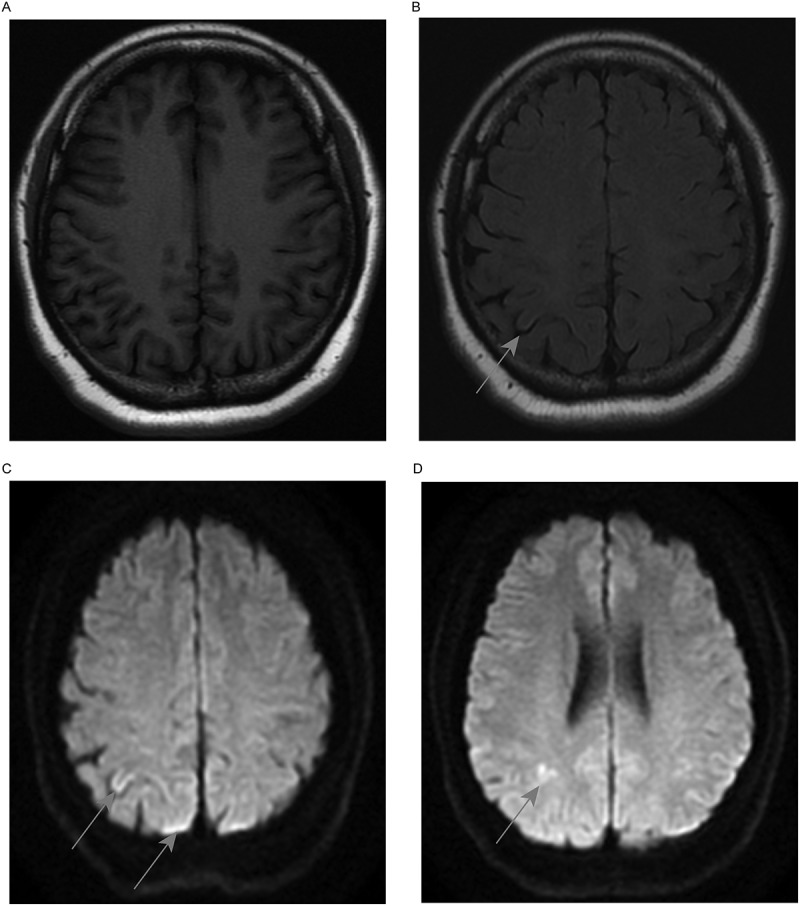 A family with mental disorder as the first symptom finally confirmed with Gerstmann-Sträussler-Scheinker disease with P102L mutation in PRNP gene - case report.