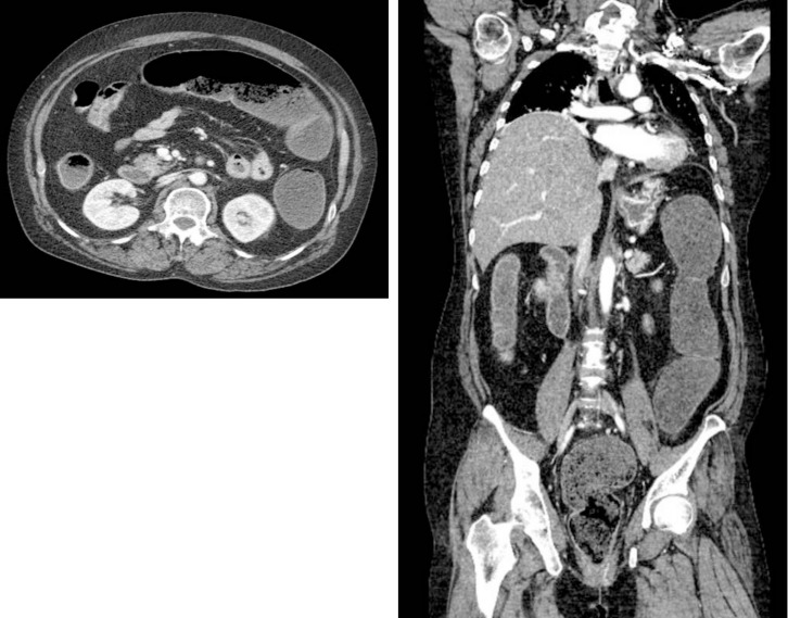 Fatal Hypermagnesemia in Patients Taking Magnesium Hydroxide.