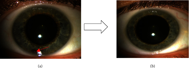 Spontaneous Hyphema during Ibrutinib Treatment in a CLL Patient.