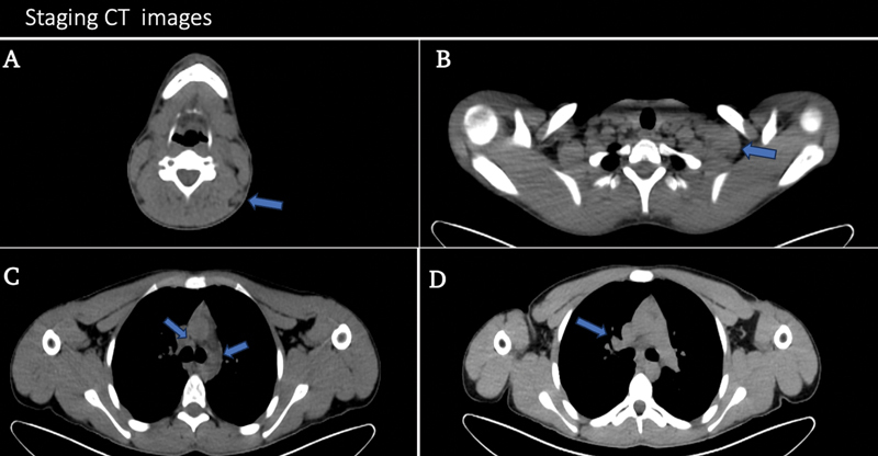 Differentiating Hodgkin Lymphoma and Sarcoid Reaction in Subsequent FDG-PET/CT: A Case Report and Literature Review.