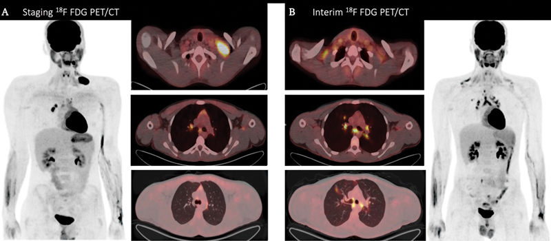 Differentiating Hodgkin Lymphoma and Sarcoid Reaction in Subsequent FDG-PET/CT: A Case Report and Literature Review.